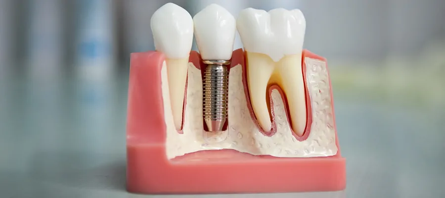 Implant Dentaire