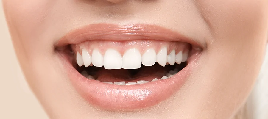 Gummy Smile